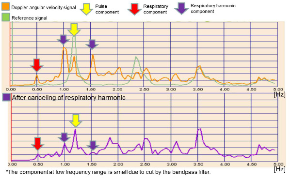 Figure 11 The efficacy of the canceling of respiratory harmonic through frequency analysis