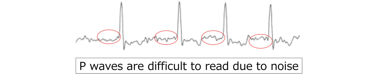 Fig. 7 EMG noise judgment