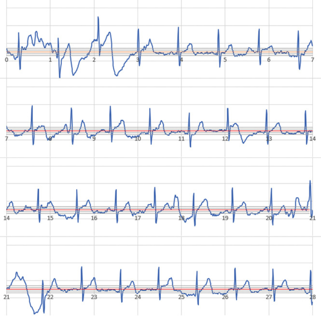 Fig. 14 Typical ECG waveform with poor recording quality