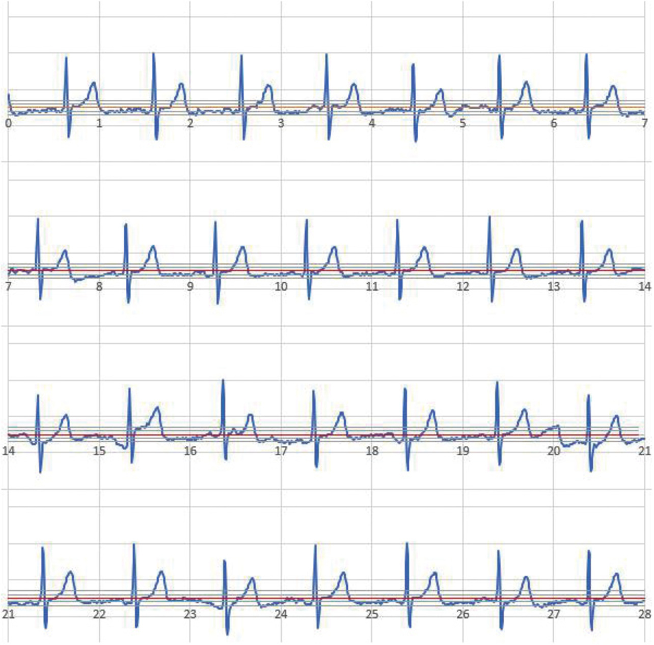Fig. 15 Typical ECG waveform with good recording quality