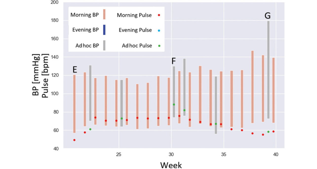 Fig. 11 Typical BP graphing (2)