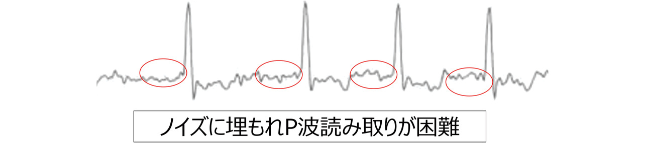 図7 筋電ノイズ判定