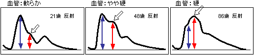 年齢によるAI値の変化